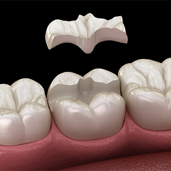 sealants